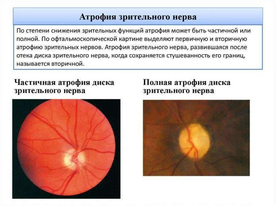 Нисходящая атрофия. Клинические признаки поражения зрительного нерва. Врожденная атрофия зрительного нерва. Неврит зрительного нерва (воспаление зрительного нерва). Атрофия зрительного нерва Лебера.