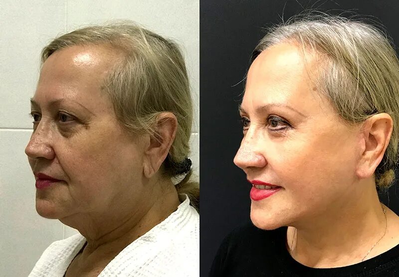 Круговая подтяжка лица шрамы. После круговой пластики. После круговой пластики. Хирургическая круговая подтяжка лица. Смас пластика лица видео.