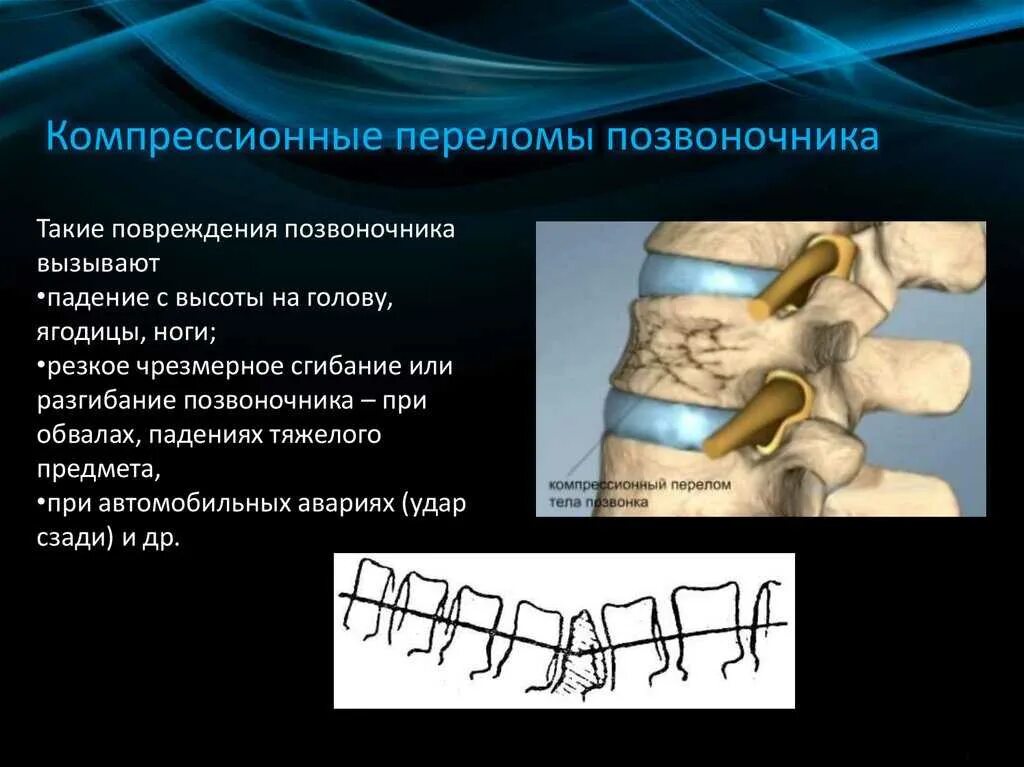 Компрессионный 4 позвонка. Компрессионный перелом позвоночника l12. компрессионный перелом позвоночника th12 l3. компрессионный перелом 6 позвонка. компрессионный перелом позвоночника 1 степени реабилитация.