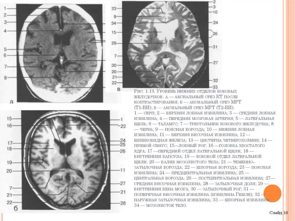 Расширение рогов боковых желудочков. Мрт головного мозга аксиальный срез. Мрт анатомия головного мозга аксиальные срезы. Нейровизуализация мрт. Мрт головного мозга фронтальный срез.