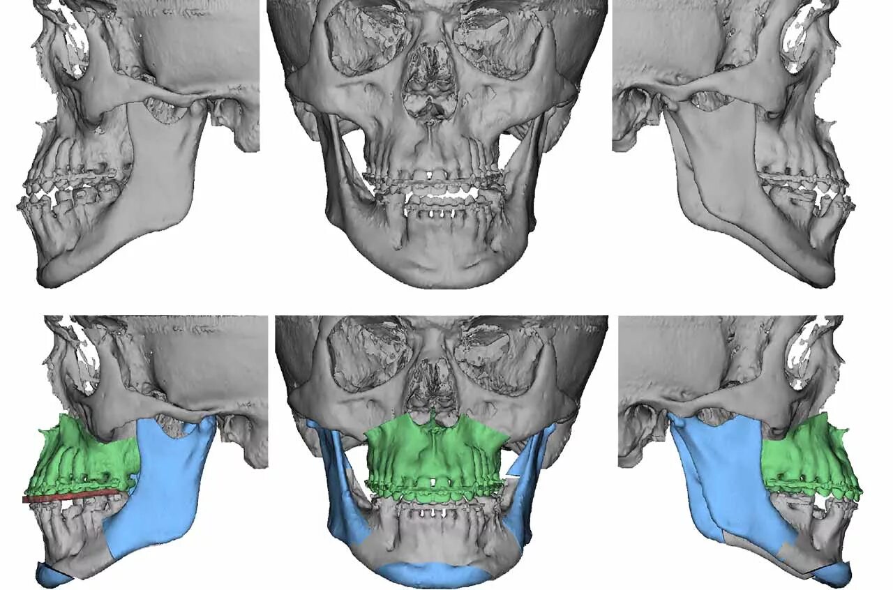 Ортогнатическая хирургия нижней челюсти. Расширение челюсти цена