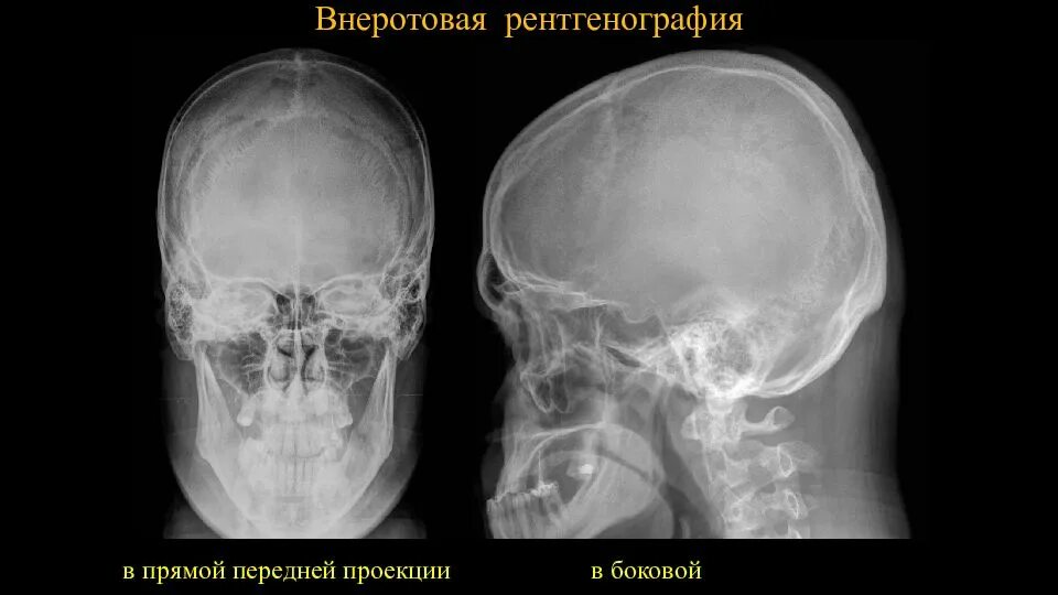 Проекции рентгенограмм черепа. Рентгенография нижней челюсти в прямой проекции. рентген боковой проекции челюсти. рентген черепа в боковой проекции.