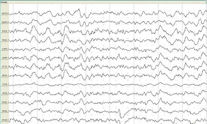Дезорганизация Альфа ритма на ЭЭГ что это. Депрессия Альфа-ритма ЭЭГ норма. ЭЭГ при панэнцефалите. ЭЭГ головного мозга норма у взрослых. Здоровая ээг