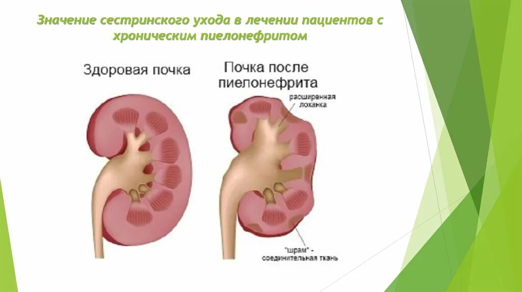 Пиелонефрит у детей какие. Мочевыделительная система почки пиелонефрит. Больной с хроническим пиелонефритом. Хронический обструктивный пиелонефрит.