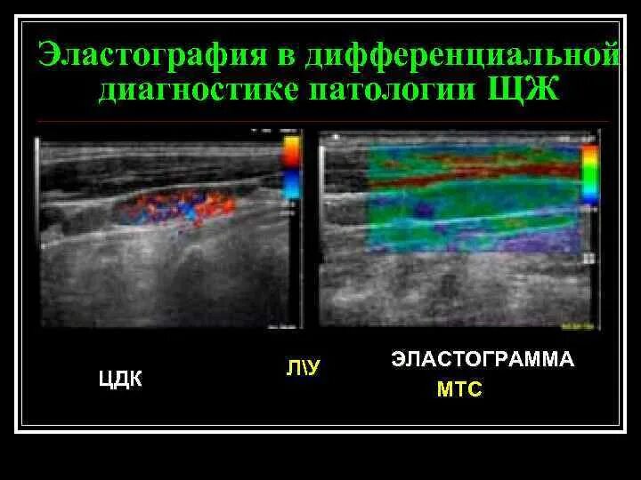 Эластография щитовидной железы что это. Эластография молочных желез шкала. Эластография 2 Тип. Эластография щитовидной. Ультразвуковая эластография молочной железы.