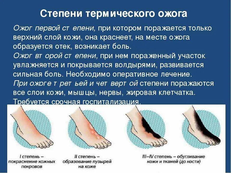 Степени ожогов и помощь. Клинические проявления термического ожога ii степени:. признаками 2-й степени термического ожога. термический ожог 1 и 2 степени симптомы и первая помощь. характеристика термического ожога 2 степени.