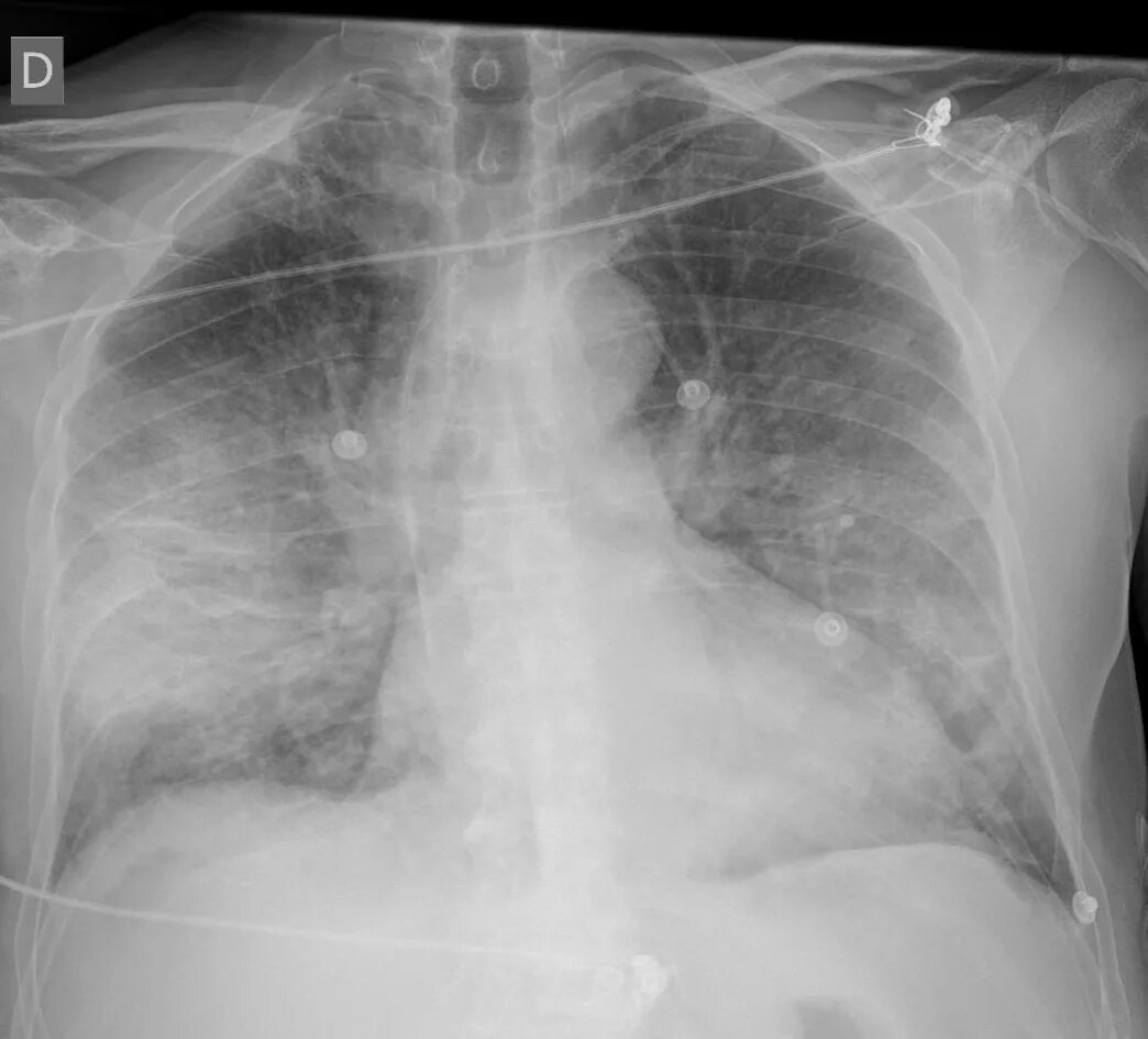 Ковид восстановление легких. Covid 19 XRAY. Бактериальная пневмония рентген. Рентген легких пневмония covid19.