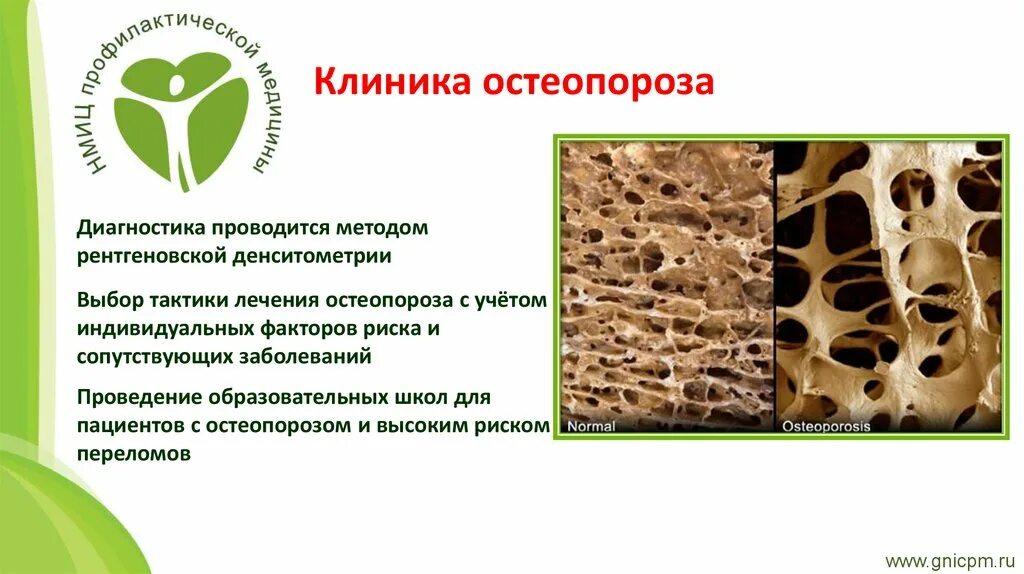 Остеопороз буклет. Листовки остеопороз. Профилактика остеопороза памятка. Ювенильный остеопороз у детей. Остеопороз буклет.