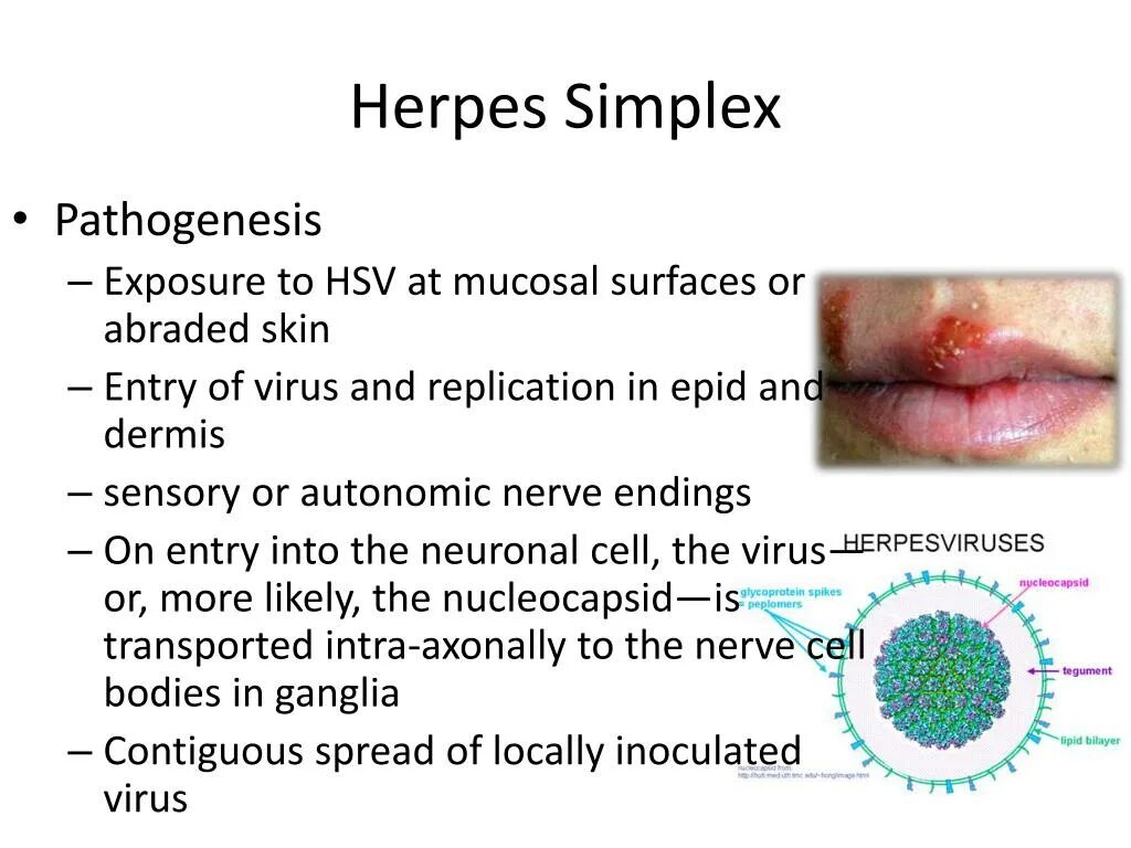 Герпес herpes Simplex virus 1,2). Вирусы простого герпеса типа 1 herpes Simplex-2.