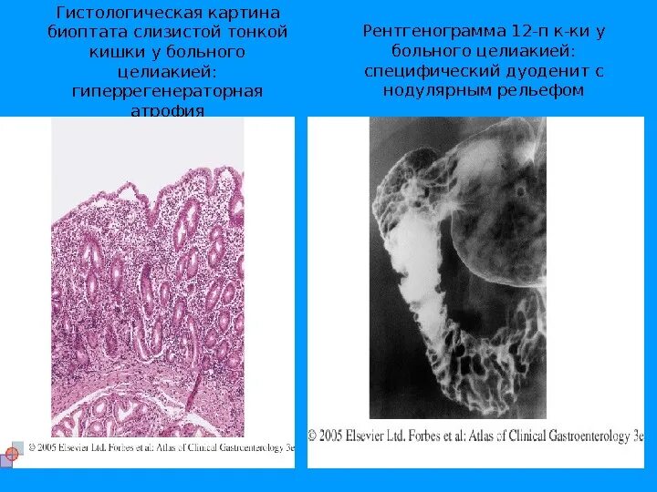 Целиакия гистологическая картина. Гистологическая картина тонкой кишки. Биоптат слизистой оболочки