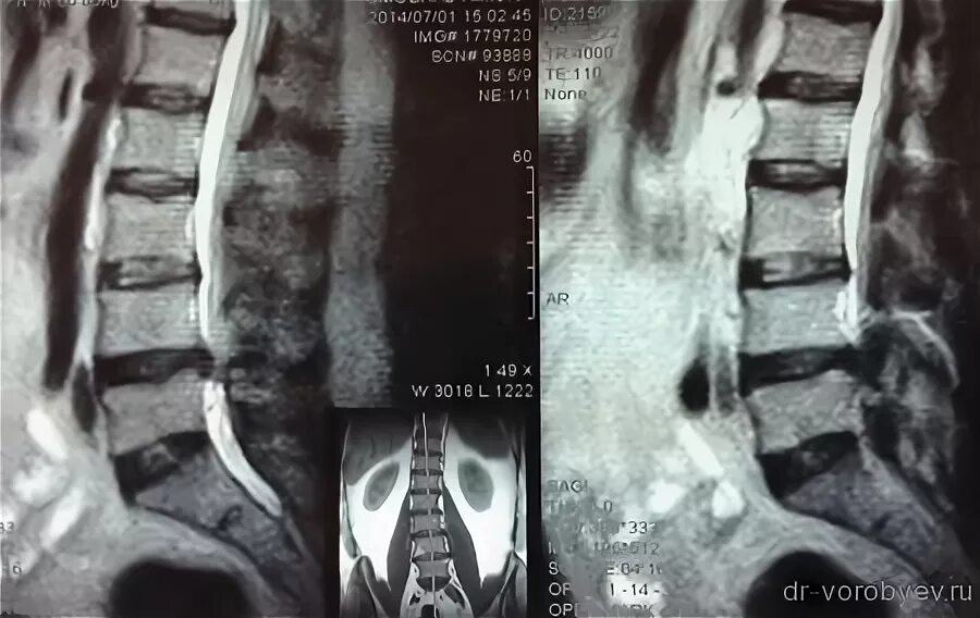 Операция по замене позвоночника. Имплантирование позвонка. Межпозвонковый имплант позвоночника. Имплант позвонка поясничного отдела. Титановый имплант в позвоночнике поясничного отдела.