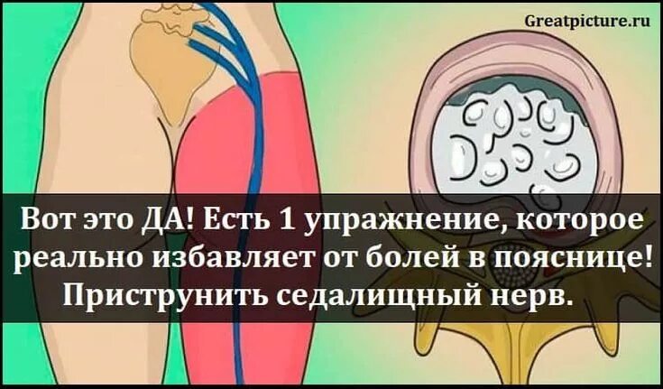 Защемление нерва при беременности 2 триместр. Упражнения от боли седалищного нерва. защемление седалищного нерва упражнения. приструнить седалищный нерв.. гимнастика при защемлении седалищного нерва.