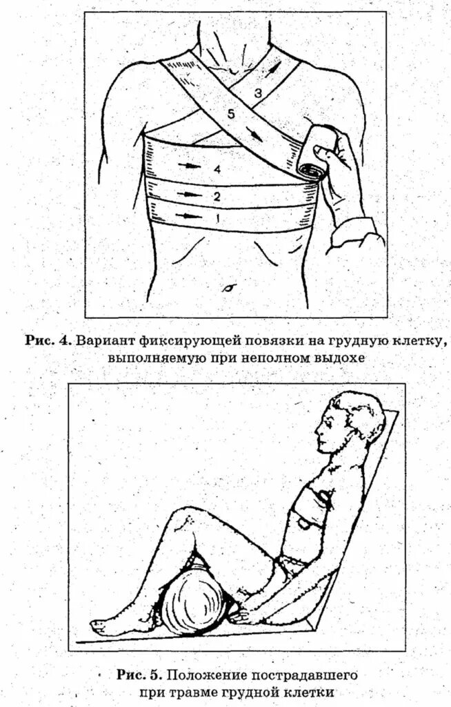 Положение при переломе и ушибе ребер