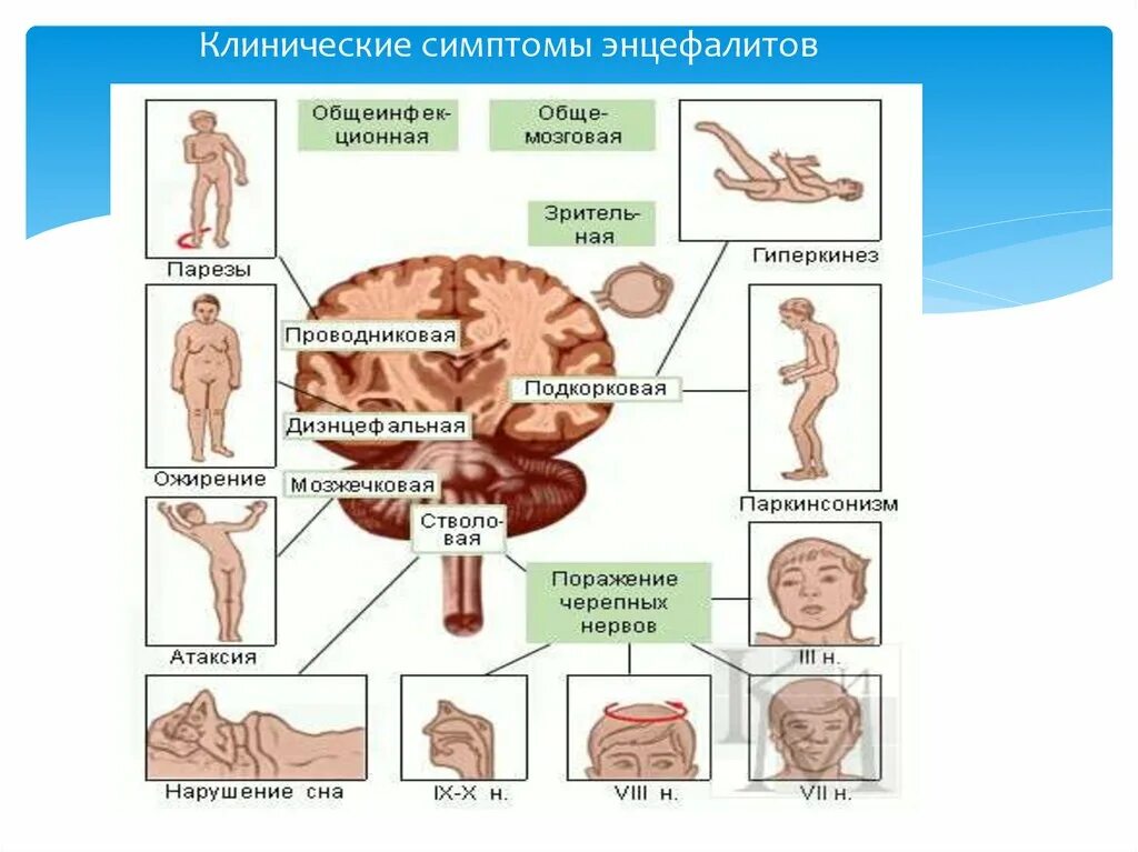 Энцефалит мозга у взрослых. Энцефалит головного мозга симптомы. Клинические симптомы энцефалита. Вирусный энцефалит головного мозга у взрослого. Энцефалит клиническая картина.