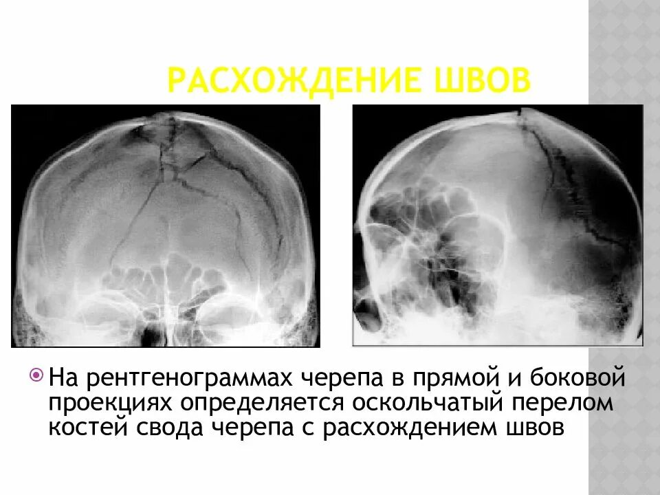 Перелом кости свода черепа. Перелом свода черепа рентген. Перелом костей свода черепа рентген. Оскольчатый перелом костей черепа. Проекции черепа в рентгенографии.