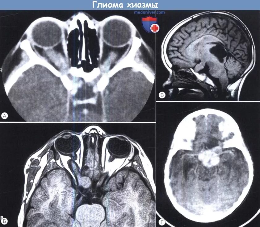Глиома у детей. Нейрофиброматоз глиома зрительного. ПЭТ кт глиома хиазмы. Глиома ствола мозга мрт. Глиома зрительного нерва мрт.