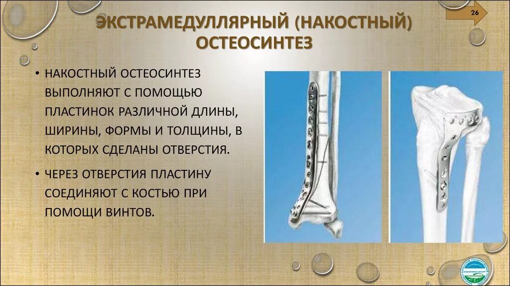 Экстрамедуллярный (накостный) остеосинтез. Перелом плечевой кости экстрамедуллярный остеосинтез. Интрамедуллярный (внутрикостный) остеосинтез. Накостный остеосинтез травматология. Этапы лечения переломов