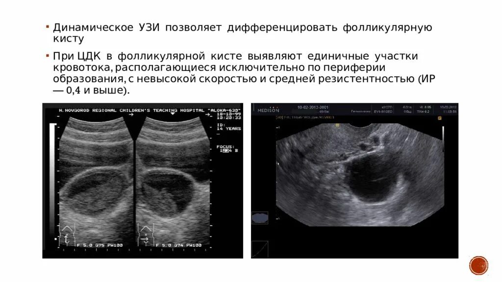 Как отличить кисту. УЗИ дифференциальный диагноз кист яичников. Эндометриоидная киста УЗИ картина. Фолликулярная киста критерии УЗИ. Фолликулярная киста на УЗИ.