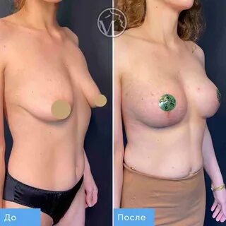 Как делают увеличение груди? 