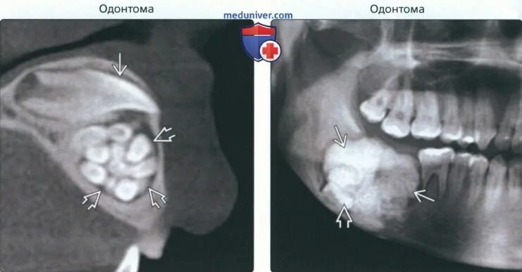 Https meduniver com medical book. Одонтома верхней челюсти кт. Одонтома верхней челюсти рентген. Одонтома нижней челюсти кт. Одонтома нижней челюсти рентген.