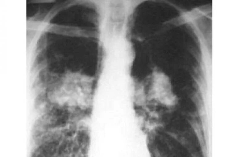 Диффузная пневмосклероз у пожилых. Пневмосклероз рентгенограмма. Пневмофиброз кортикальный. Диффузный пневмосклероз рентген.