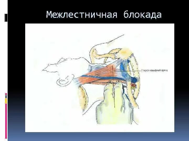 Блокада сплетения. Межлестничная анестезия. Блокада плечевого сплетения межлестничным доступом техника. Осложнения межлестничной блокады плечевого сплетения. Блокада плечевого сплетения межлестничным доступом по Соколовскому.