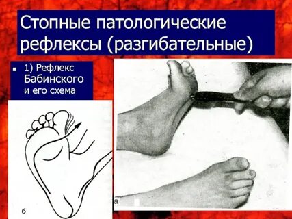Рефлекс стопы