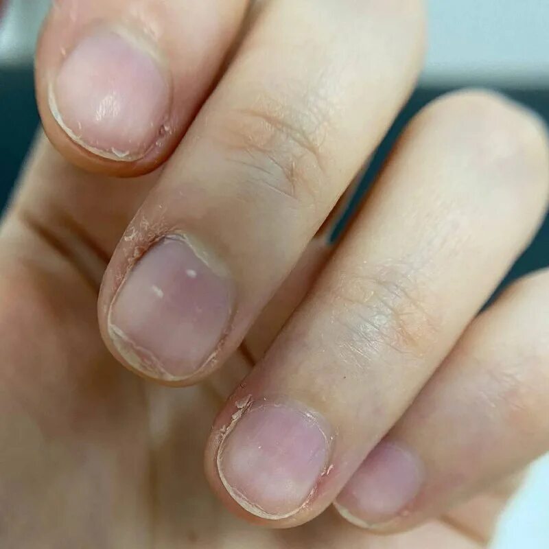 сухой европейский маникюр. плотной кутикулы. воспаление кутикулы на пальце. европейский маникюр. необработанная кутикула.