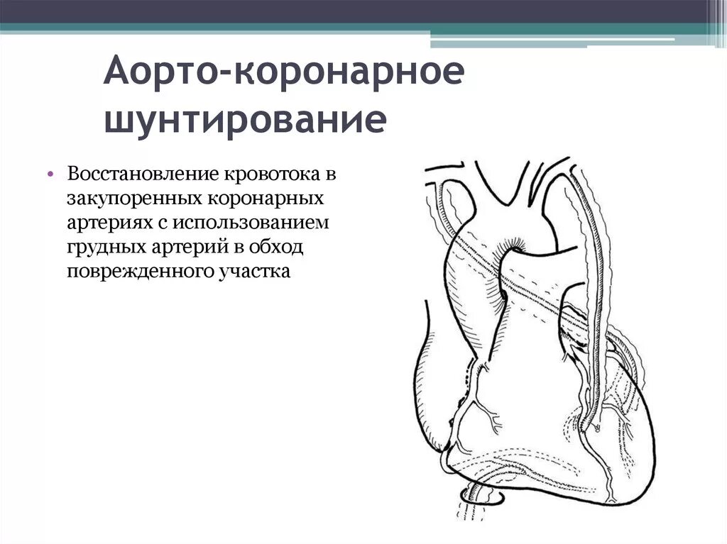 Схема операции аортокоронарного шунтирования. Билатеральное маммарокоронарное шунтирование. Аорто маммарно коронарное шунтирование это. Аорто аортальное шунтирование. Как делают коронарное шунтирование