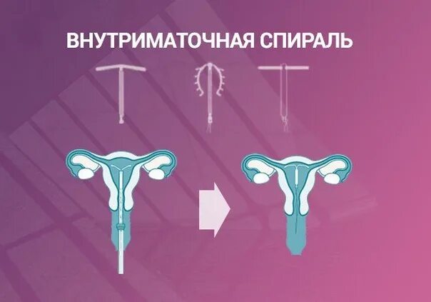 Как можно снять спираль Внутриматочная спираль: виды, цены, как выбрать лучшую мирена, юнона, нова, му