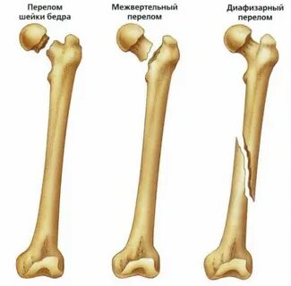 Какие кости легко сломать