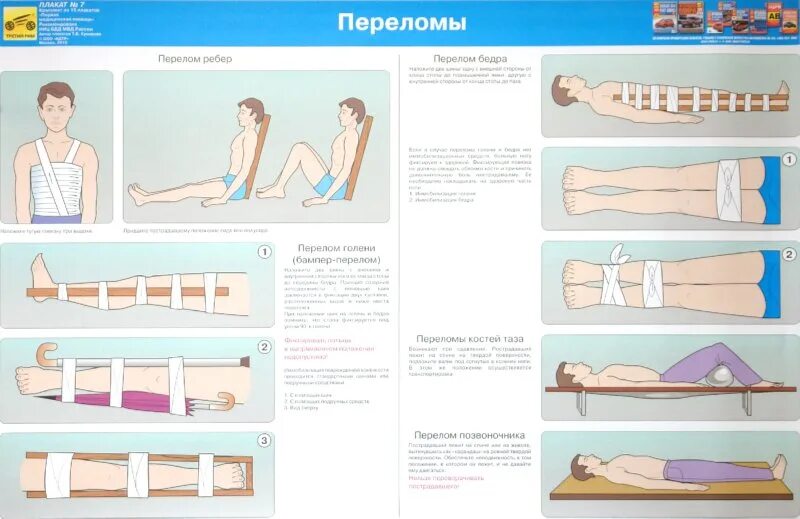 Перелом голени транспортировка. Транспортировка пострадавшего с переломом бедра. Транспортировка больных при переломах конечностей. Транспортировка припереломпх. Первая помощь при переломах.