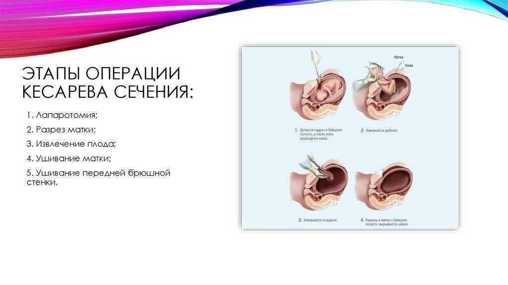 Этапы кесарева сечения кесарево операции. Этапы операции кесарева сечения. Этапы операции кесарево сечение послойно. При проведении операции кесарева сечения премедикацию осуществляют.