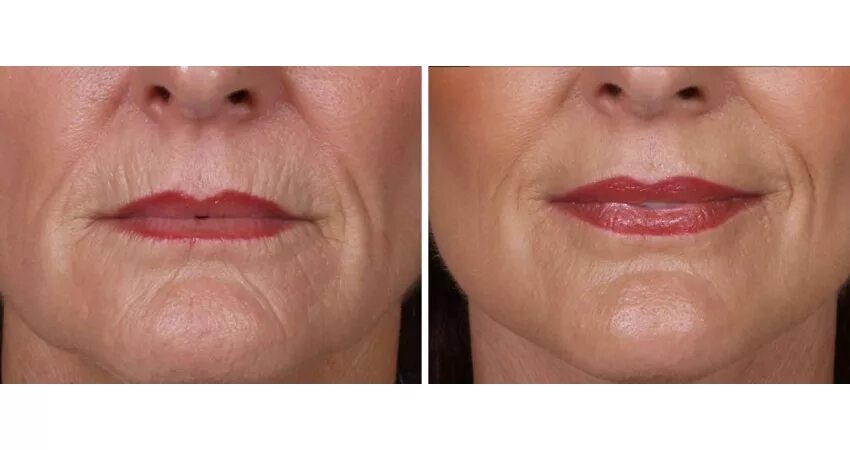 Лазер губы. Татуаж губ после лазера. Лазерное омоложение губ smooth lips. Лазер губы. Синие губы после перманентного макияжа.