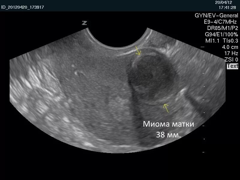 Интрамуральная миома матки УЗИ. Интрамуральная миома на УЗИ. Интрамуральный миоматозный узел. Шеечный миоматозный узел. Узи при миоме матки на какой день