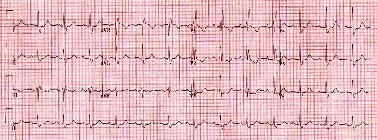 Блокада правого желудочка. Блокада ПНПГ на ЭКГ. Комплекс QRS В v1. БЛНПГ на ЭКГ. RSR форма v1/v2.