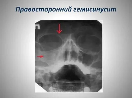 Острый левосторонний катаральный