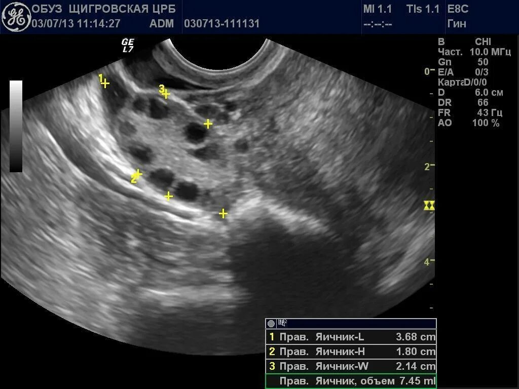 Жёлтое тело в яичнике на УЗИ 19мм. Функциональная киста яичника на УЗИ. Поликистоз яичников на УЗИ.