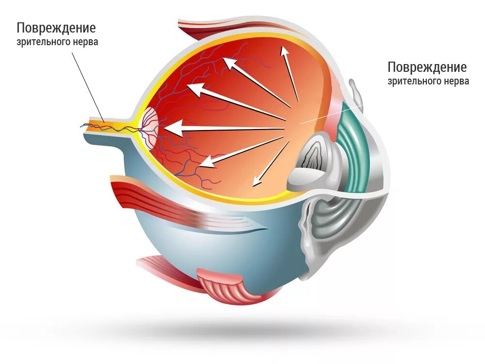 Глазное давление глаукома. Глаукома строение глаза.