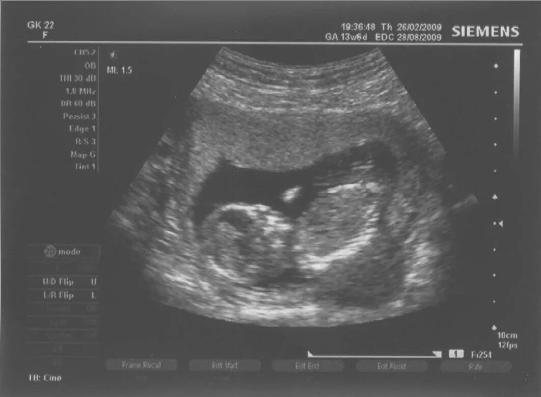 Ребёнок на 13 неделе беременности. Беременность 13 недель и два дня. 13 неделя коричневые