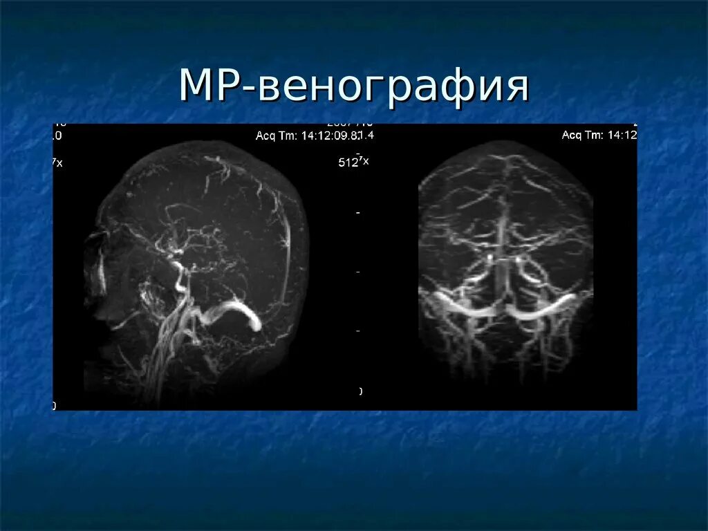 Венография головного мозга