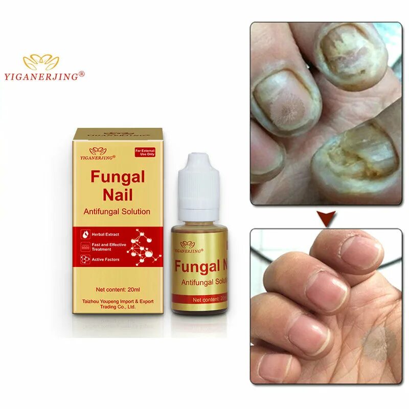 Китайское средство от грибка fungal Nail treatment. Fungal treatment solution для ногтей. Средство от грибка ногтей fungal Nail Renewal. Средство от грибка и онихолизиса ногтей. Онихолизис лекарство купить