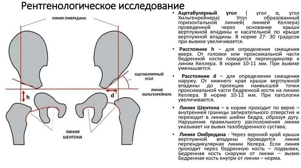 Мкб дисплазия тазобедренных суставов детей. Показатели дисплазии тазобедренных суставов у ребенка. дисплазия тазобедренных суставов схема. ацетабулярный угол рентген тазобедренных суставов. показатели дисплазии тазобедренных суставов.