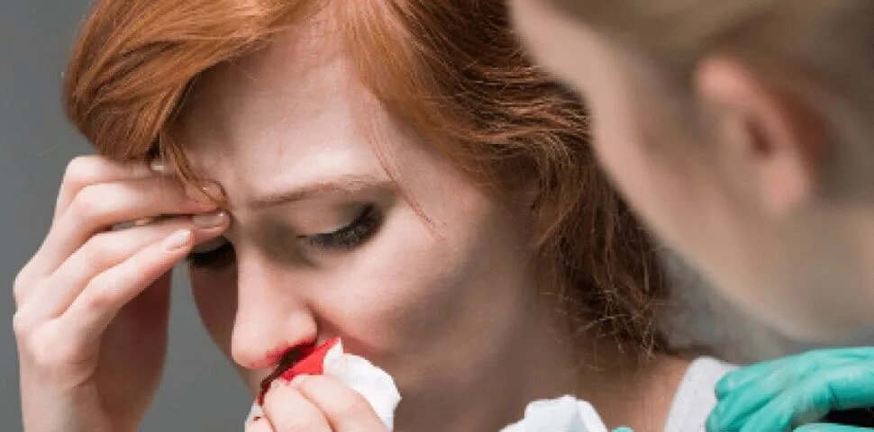 Носовое кровотечение из носа