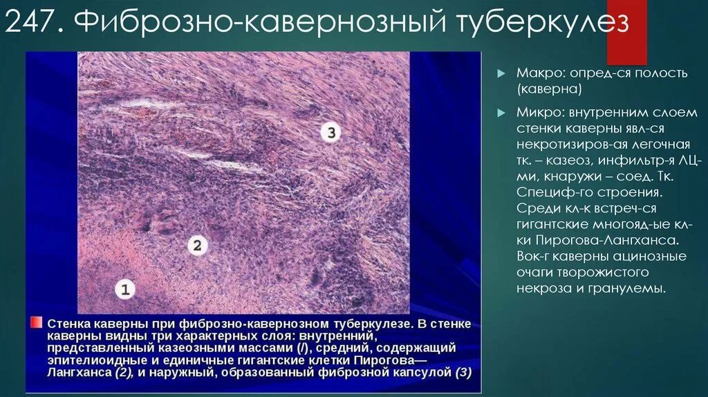 Что означает фиброзное изменение