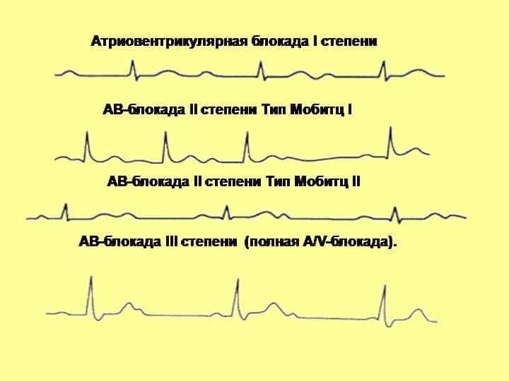 Атриовентрикулярная блокада признаки. ЭКГ при атриовентрикулярной блокаде. ЭКГ признаки полной атриовентрикулярной блокады. ЭКГ критерии АВ блокады 1 степени. Атриовентрикулярная блокада степени на ЭКГ.
