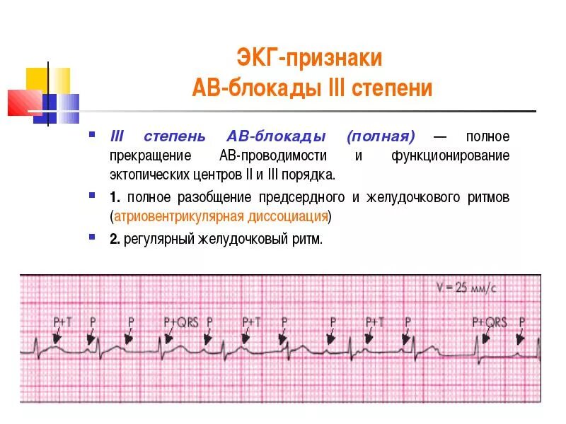 Атриовентрикулярная блокада 2. Атриовентрикулярная блокада 2 степени 3 Тип. Атриовентрикулярная блокада 2 степени на ЭКГ. Av блокада 2 степени 2 типа на ЭКГ. ЭКГ критерии АВ блокады 2 степени Мобитц 2.