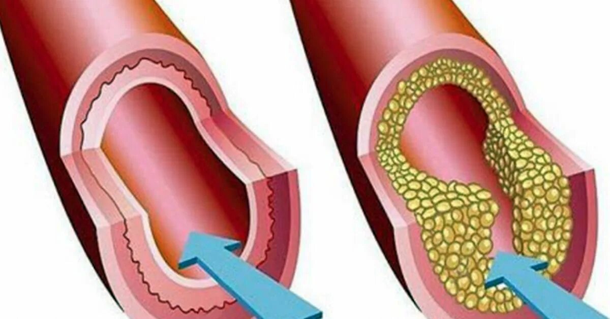 Холестериновые бляшки в сосудах. Склеротические бляшки.