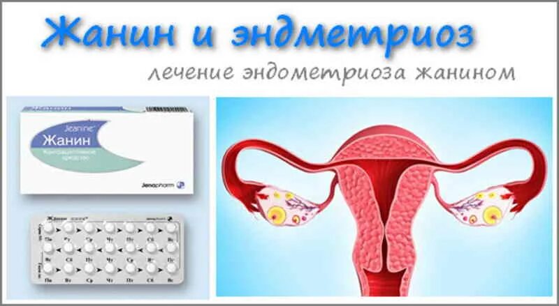 Как вылечить эндометриоз без гормонов. Эндометриоз жанин. эндометриоз таблетки. гормональные таблетки для женщин при эндометриозе. жанин таблетки при эндометриозе.