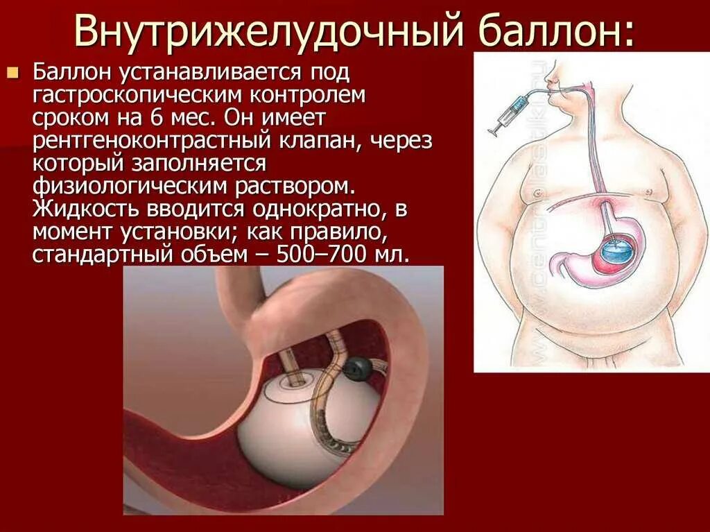 Суть операции шарика. Внутрижелудочный баллон. Баллон в желудок для похудения. Операция внутрижелудочный баллон. Баллончик в желудок для похудения.